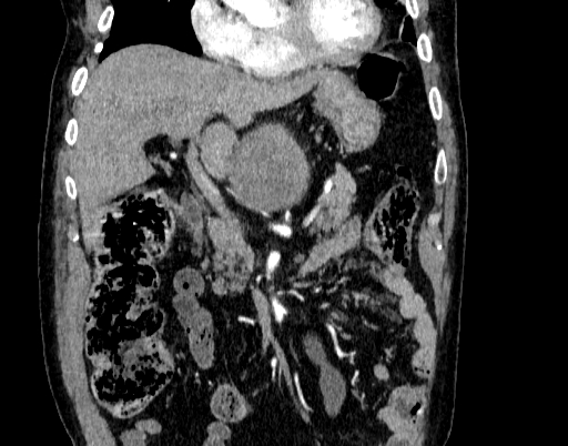 Abdominal aortic aneurysm (Radiopaedia 67117-76452 Coronal C+ arterial phase 24).jpg