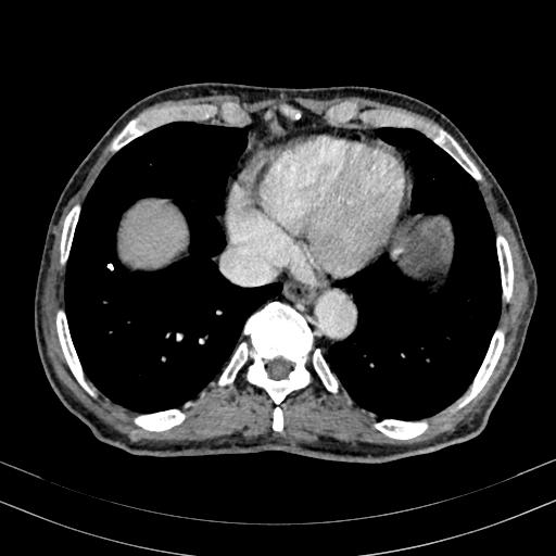 Abdominal aortic aneurysm (Radiopaedia 83581-98689 Axial C+ portal venous phase 8).jpg