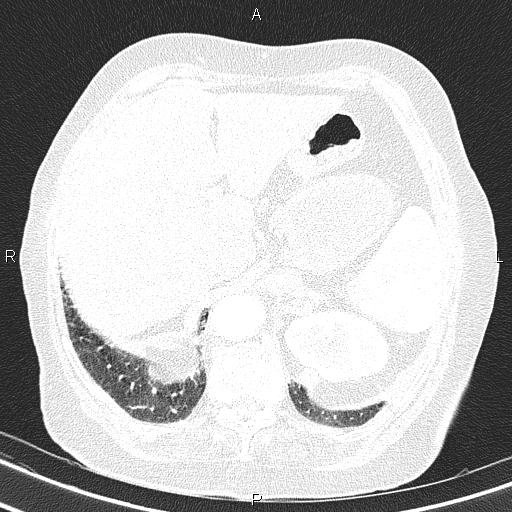 Abdominal aortic aneurysm (Radiopaedia 85063-100606 Axial lung window 60).jpg