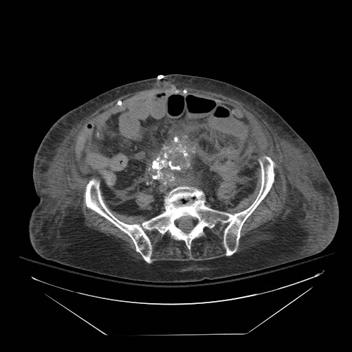 Abdominal aortic aneurysm - impending rupture (Radiopaedia 19233-19247 Axial non-contrast 116).jpg