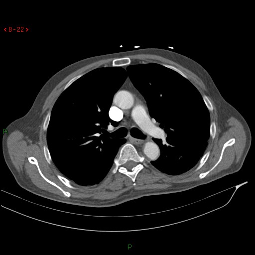 Abdominal aortic aneurysm rupture with aortocaval fistula (Radiopaedia 14897-14841 Axial C+ arterial phase 22).jpg