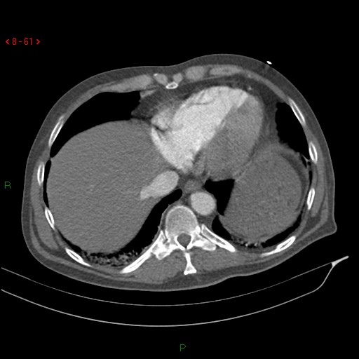 Abdominal aortic aneurysm rupture with aortocaval fistula (Radiopaedia 14897-14841 Axial C+ arterial phase 61).jpg