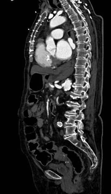 Abdominal aortic aneurysm with thrombus fissuration (Radiopaedia 73192-83919 Sagittal C+ arterial phase 61).jpg