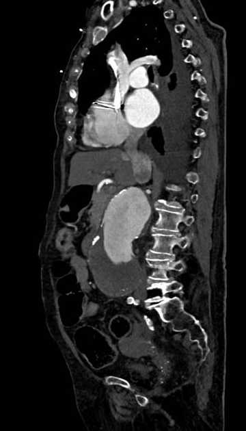 Abdominal aortic aneurysm with thrombus fissuration (Radiopaedia 73192-83919 Sagittal C+ arterial phase 80).jpg