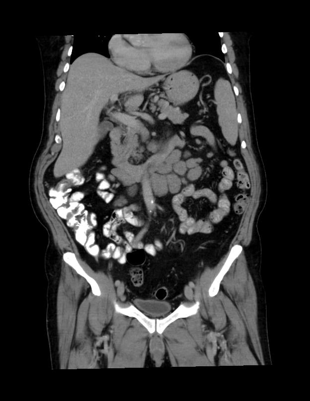 Abdominal lymphoma - with sandwich sign (Radiopaedia 53486-59492 C+ portal venous phase 33).jpg