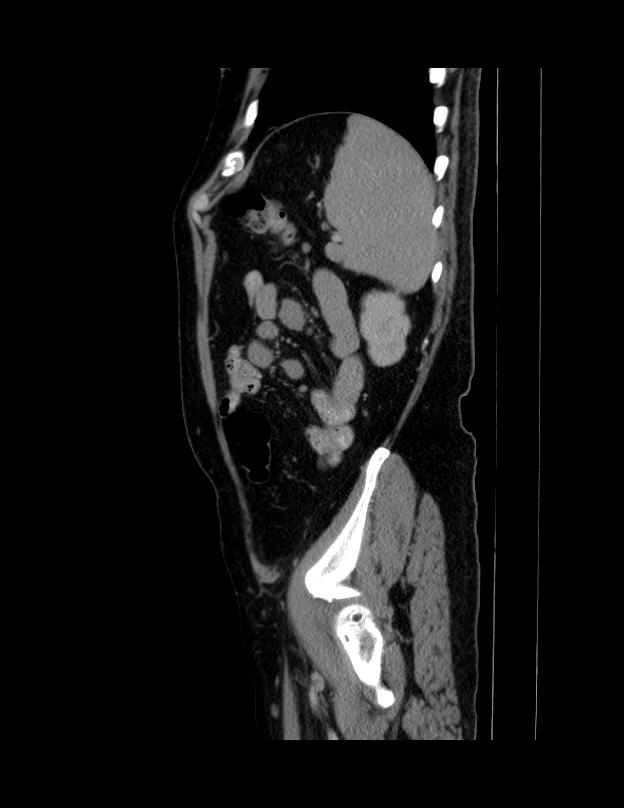 Abdominal lymphoma - with sandwich sign (Radiopaedia 53486-59492 Sagittal C+ portal venous phase 13).jpg