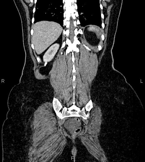 Abdominal lymphoma with sandwich sign (Radiopaedia 84378-99704 Coronal C+ portal venous phase 59).jpg