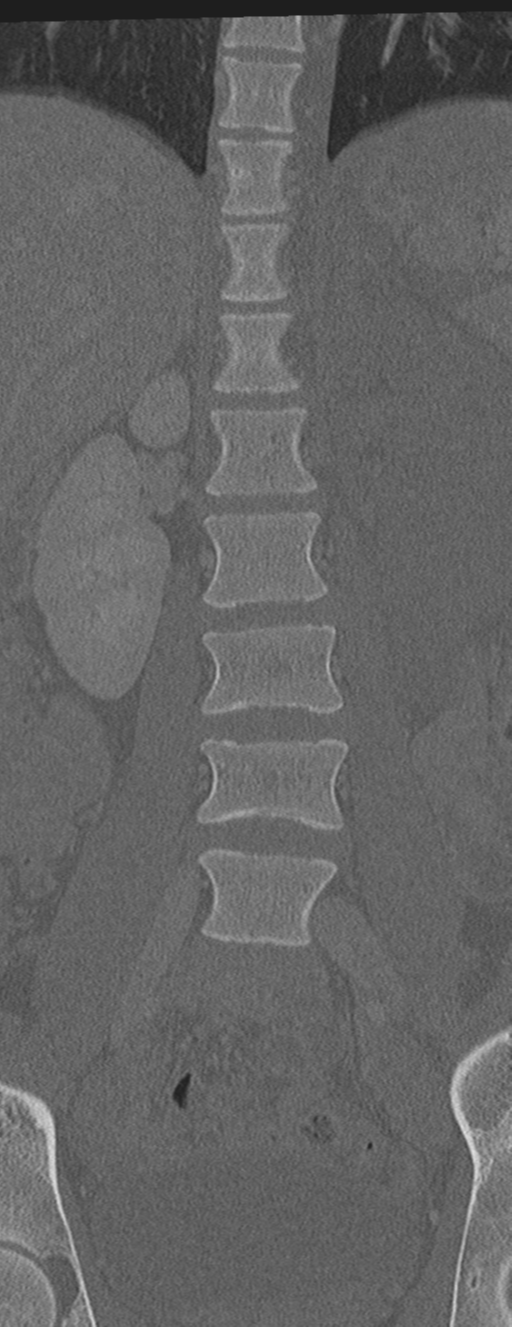 Abdominal multi-trauma - devascularised kidney and liver, spleen and pancreatic lacerations (Radiopaedia 34984-36486 Coronal bone window 22).png