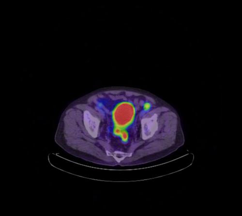Abdominal wall metastasis from colorectal carcinoma (Radiopaedia 31016-31719 Axial 32).jpg