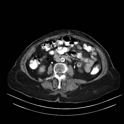 File:Abdominal wall recurrence after colorectal resection for cancer (Radiopaedia 23444-23523 Axial C+ portal venous phase 16).jpg