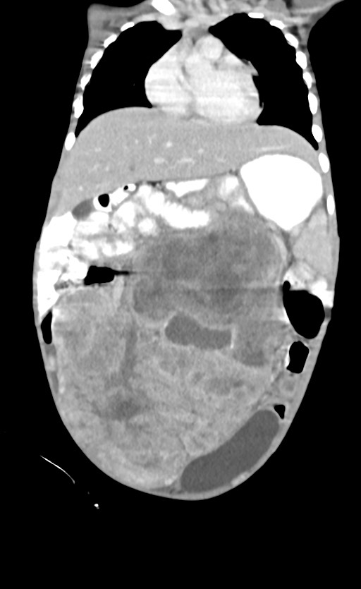Abdominopelvic rhabdomyosarcoma (Radiopaedia 78356-90984 Coronal C+ portal venous phase 32).jpg