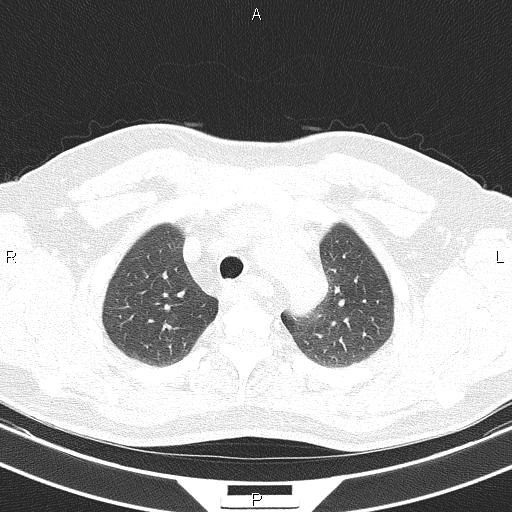 File:Aberrant right subclavian artery (Radiopaedia 87093-103354 Axial lung window 23).jpg
