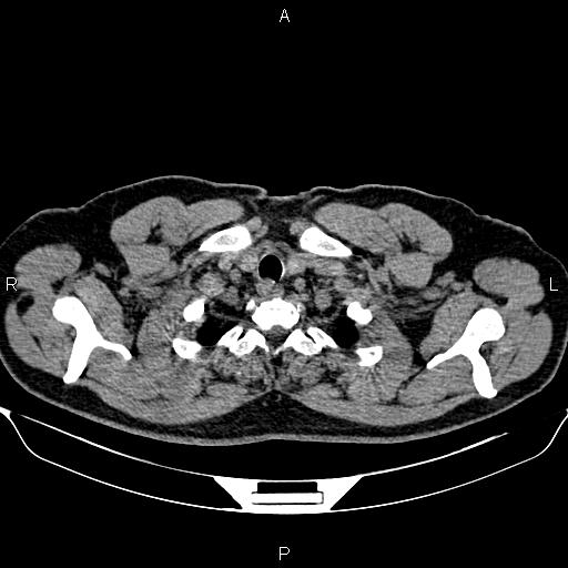 Aberrant right subclavian artery (Radiopaedia 87093-103354 Axial non-contrast 8).jpg