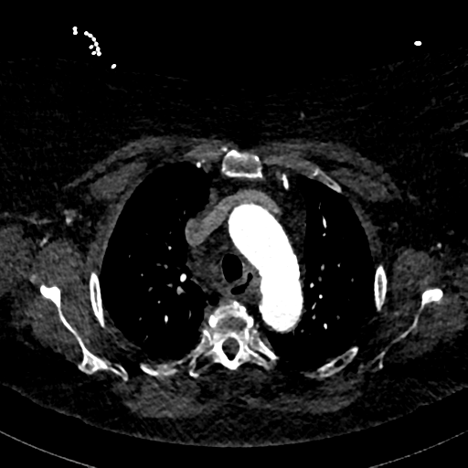 File:Aberrant right subclavian artery with Kommerell diverticulum (Radiopaedia 47982-52769 Axial C+ arterial phase 27).png