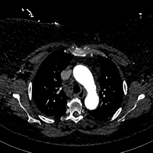 Aberrant right subclavian artery with Kommerell diverticulum (Radiopaedia 47982-52769 Axial C+ arterial phase 29).png