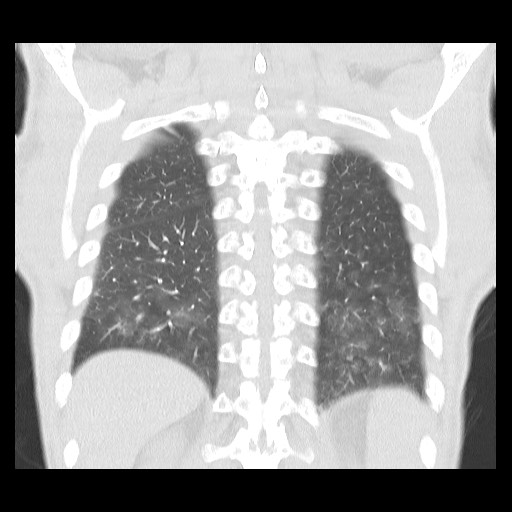 Accessory left horizontal fissure with lingular pneumonia (Radiopaedia 53763-59843 Coronal lung window 37).jpg