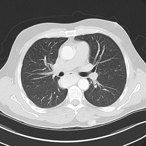 Achalasia of the cardia (Radiopaedia 38497-40595 Axial lung window 24).png