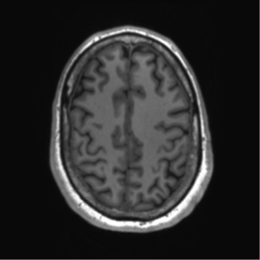 File:Achondroplasia (Radiopaedia 65109-74105 Axial T1 12).png