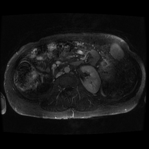 Acinar cell carcinoma of the pancreas (Radiopaedia 75442-86668 Axial T1 C+ fat sat 17).jpg