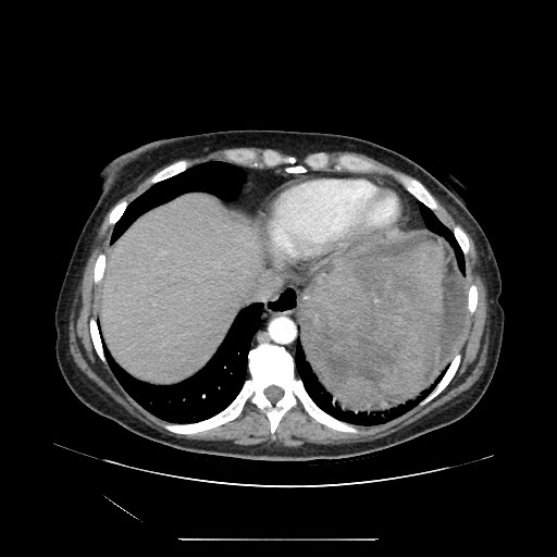 Acinar cell carcinoma of the pancreas (Radiopaedia 75442-86669 Axial C+ portal venous phase 13).jpg
