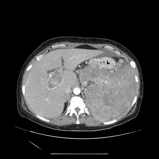 Acinar cell carcinoma of the pancreas (Radiopaedia 75442-86669 Axial C+ portal venous phase 32).jpg