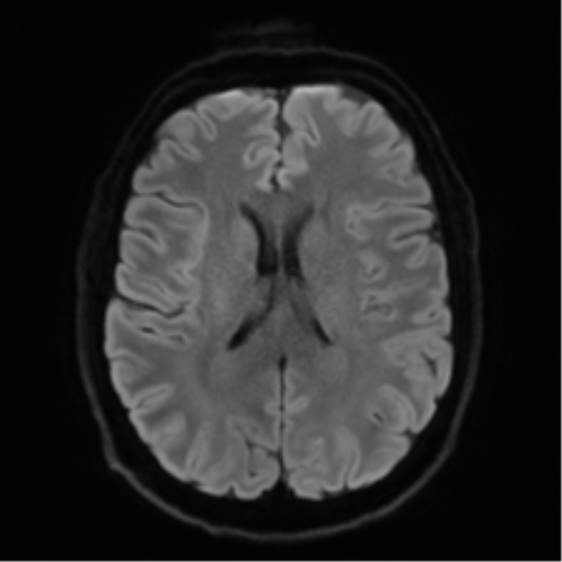 Acoustic schwannoma (Radiopaedia 50846-56358 Axial DWI 45).png
