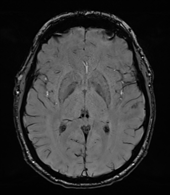 Acoustic schwannoma (Radiopaedia 50846-56358 Axial SWI 48).png