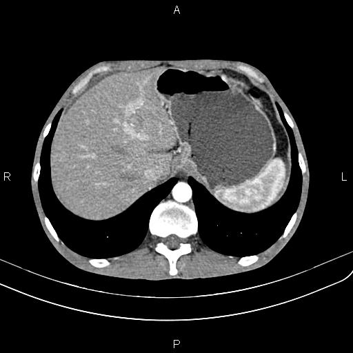 Active crohn disease (Radiopaedia 87133-103397 Axial C+ arterial phase 20).jpg