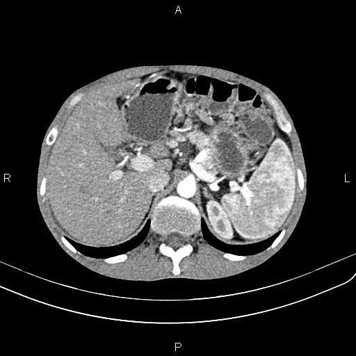 Active crohn disease (Radiopaedia 87133-103397 Axial C+ arterial phase 29).jpg