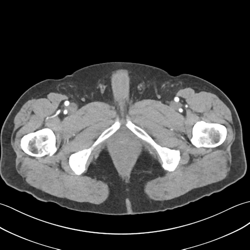 File:Active diverticular hemorrhage (Radiopaedia 39415-41725 Axial C+ arterial phase 77).png