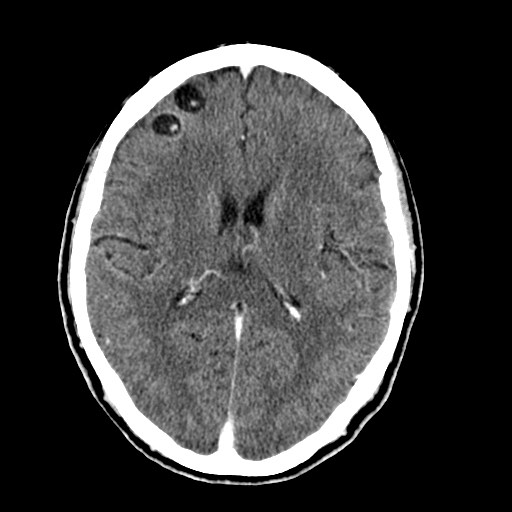 File:Active neurocysticercosis before and after therapy (Radiopaedia 71710-82099 Axial C+ delayed 43).jpg