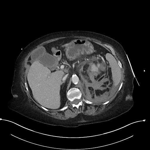 File:Active renal extravasation with large subcapsular and retroperitoneal hemorrhage (Radiopaedia 60975-68796 Axial 291).jpg