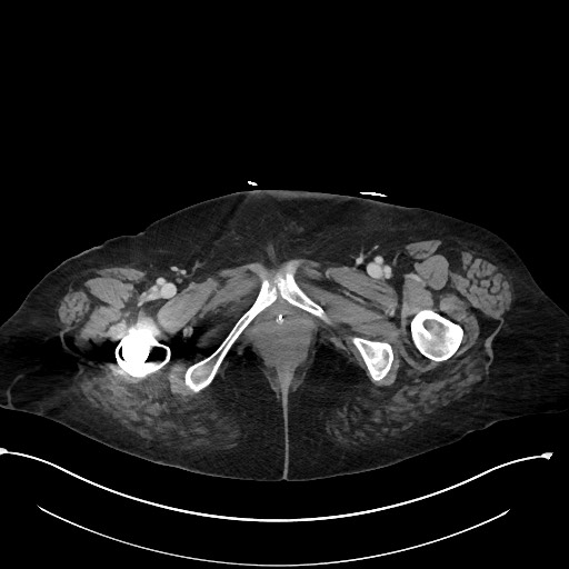 File:Active renal extravasation with large subcapsular and retroperitoneal hemorrhage (Radiopaedia 60975-68796 Axial 350).jpg