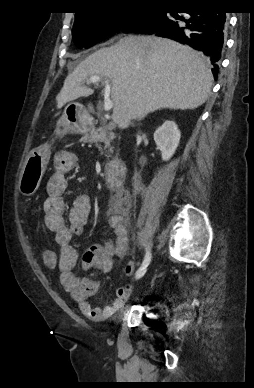 Active renal extravasation with large subcapsular and retroperitoneal hemorrhage (Radiopaedia 60975-68796 Sagittal C+ portal venous phase 141).jpg