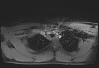 File:Active right ventricular cardiac sarcoidosis (Radiopaedia 55596-62100 Axial Post contrast Dixon 3).jpg