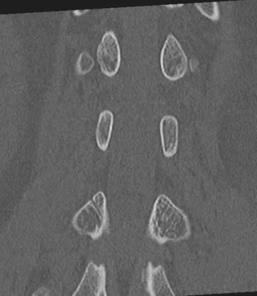 Acute L1 burst compression fracture (Radiopaedia 34430-35755 Coronal bone window 39).png