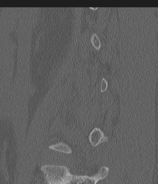 Acute L1 burst compression fracture (Radiopaedia 34430-35755 Sagittal bone window 50).png