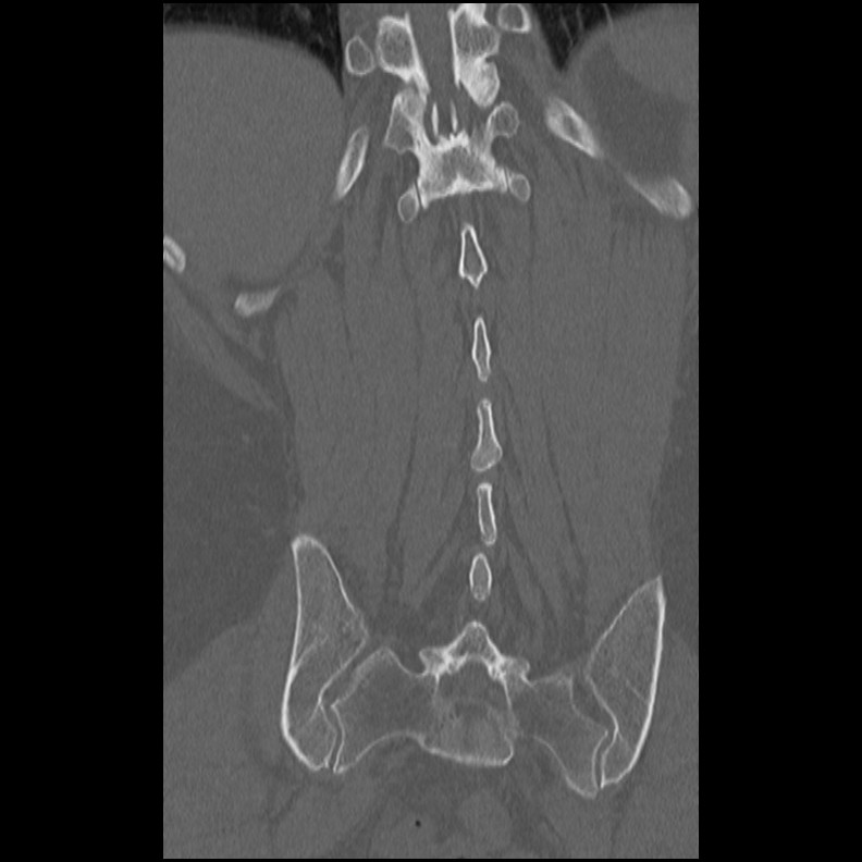 Acute Schmorl's node (Radiopaedia 83276-102365 Coronal bone window 46).jpg