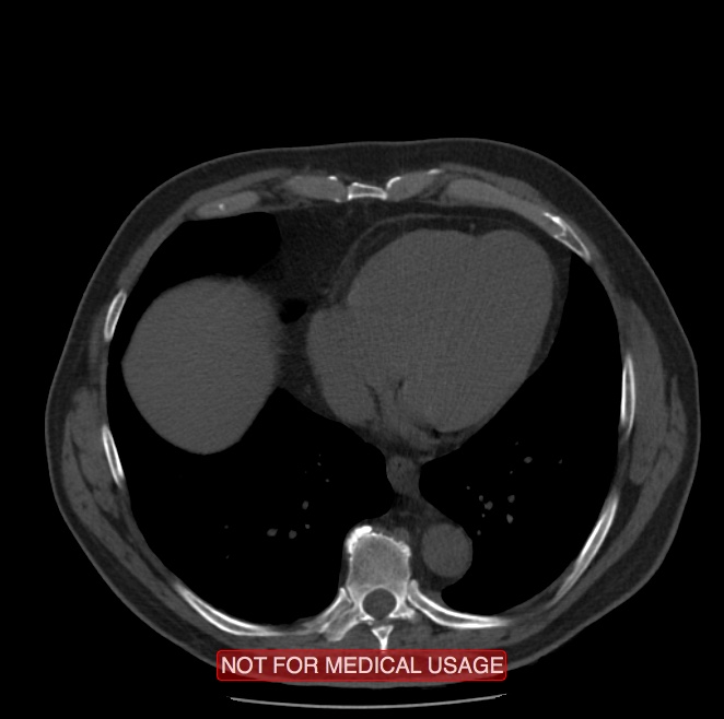 Acute aortic dissection - Stanford type A (Radiopaedia 40661-43285 Axial non-contrast 48).jpg