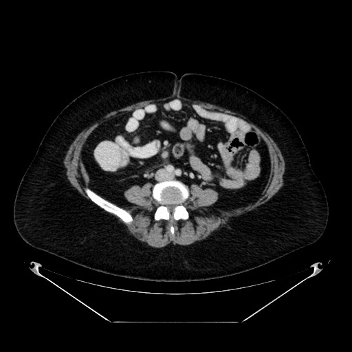 Acute appendicitis, heterotaxy syndrome (Radiopaedia 66884-76202 Axial C+ portal venous phase 79).jpg