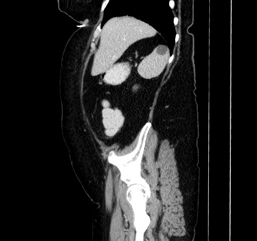 File:Acute appendicitis, heterotaxy syndrome (Radiopaedia 66884-76202 Sagittal C+ portal venous phase 35).jpg