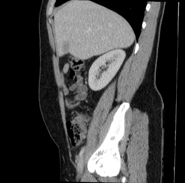Acute appendicitis (Radiopaedia 38255-40270 Sagittal C+ portal venous phase 25).jpg