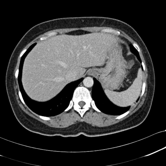File:Acute appendicitis (Radiopaedia 48792-53822 Axial C+ portal venous phase 17).jpg