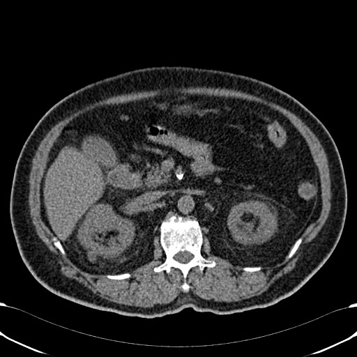 File:Acute appendicitis (Radiopaedia 58627-65818 Axial non-contrast 33).jpg