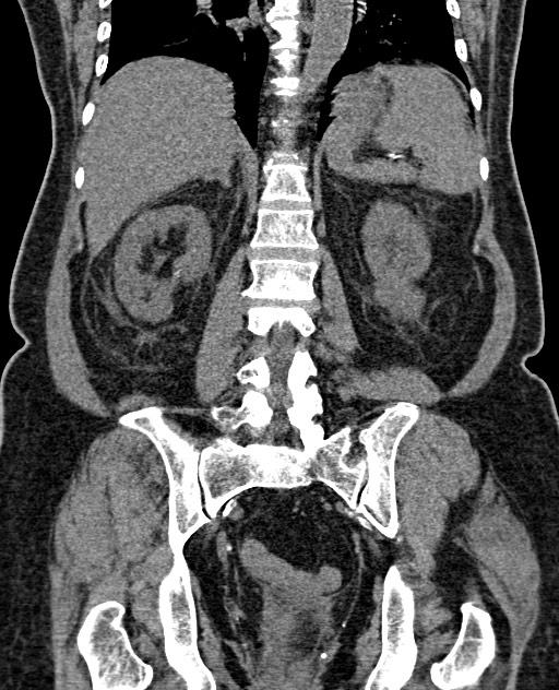 Acute appendicitis (Radiopaedia 58627-65818 Coronal non-contrast 49).jpg