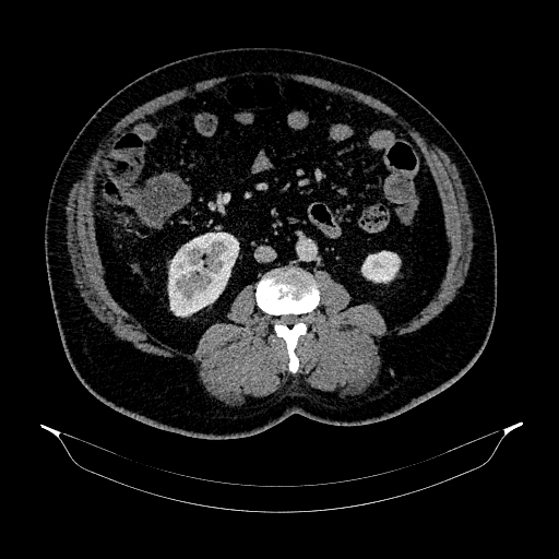 Acute appendicitis (Radiopaedia 79950-93224 Axial C+ portal venous phase 53).jpg