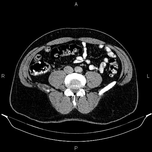 File:Acute appendicitis (Radiopaedia 84780-100240 Axial C+ portal venous phase 68).jpg