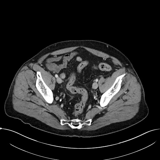 File:Acute appendicitis - large appendicoliths (Radiopaedia 61805-69820 Axial C+ portal venous phase 108).jpg