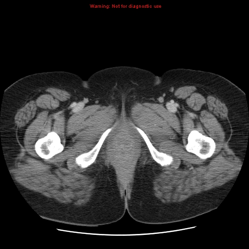 File:Acute appendicitis complicated by ovarian vein thrombophlebitis (Radiopaedia 16172-15851 Axial C+ portal venous phase 93).jpg