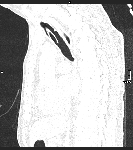 File:Acute aspiration pneumonitis (Radiopaedia 55642-62166 Sagittal lung window 80).jpg